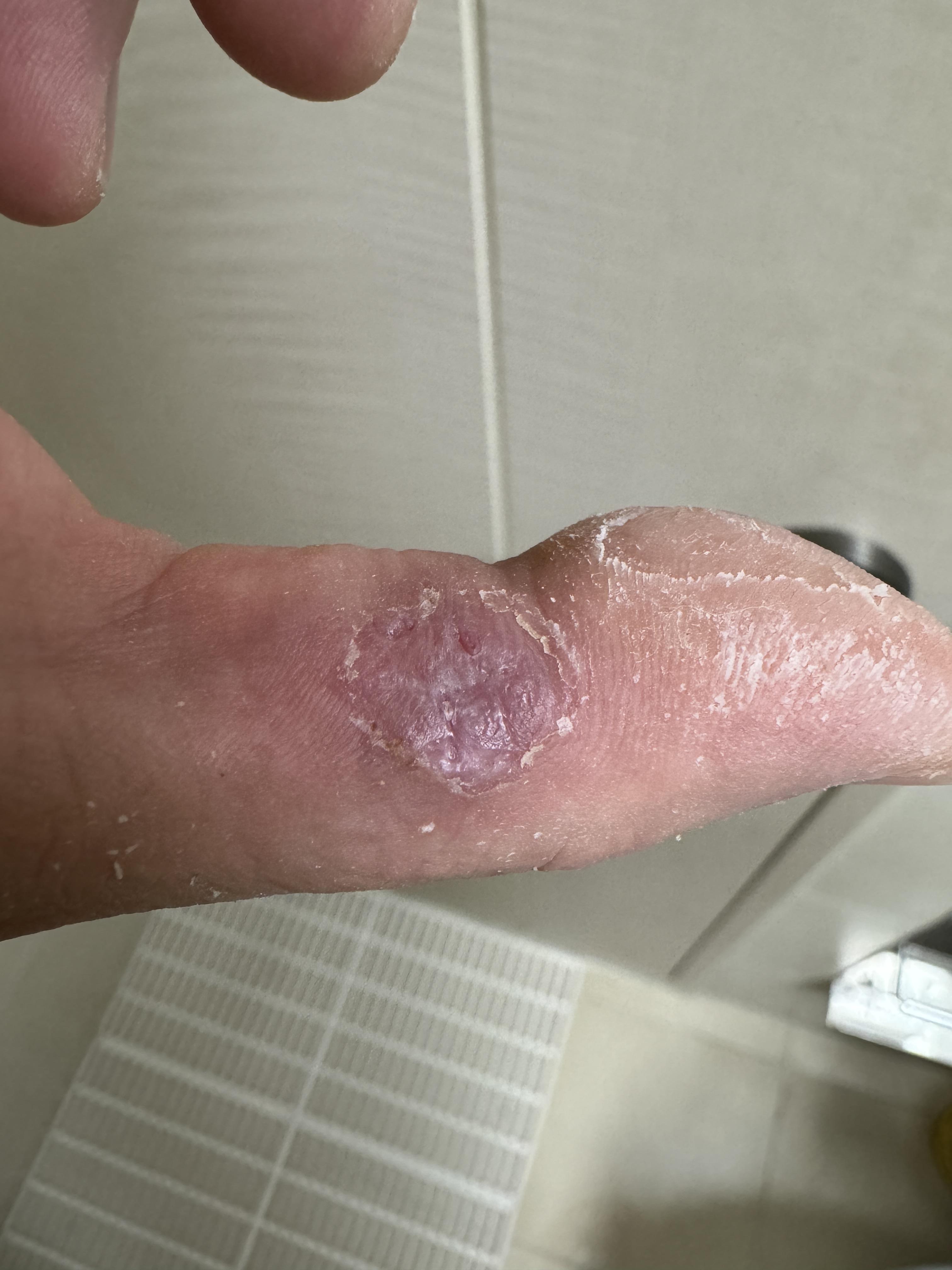 엄지손가락 티눈 수술 실밥 제거 후 하루 경과 — 새살이 올라온 환부