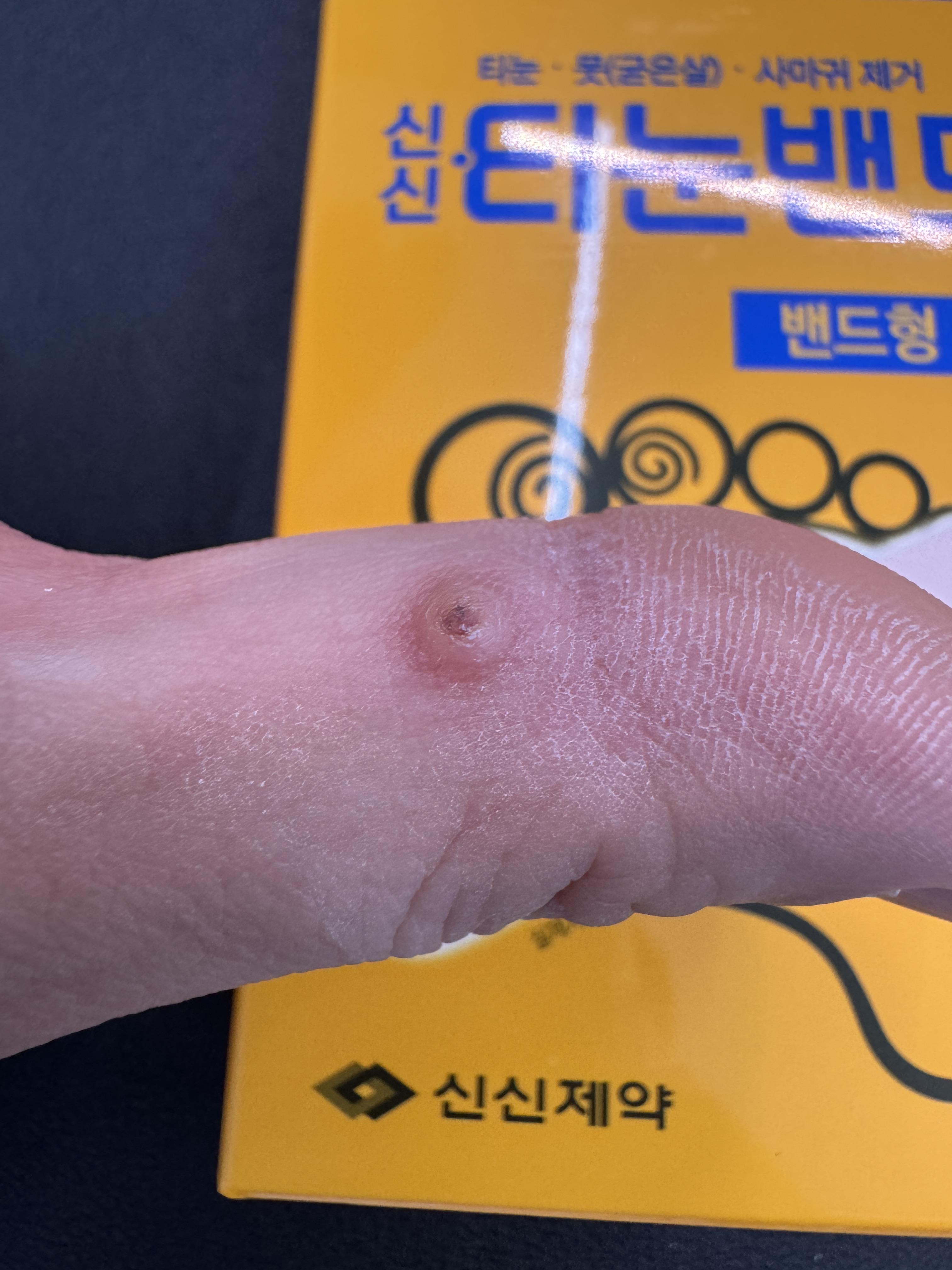 신신 티눈 밴드 2일차 — 주변이 하얗게 부풀기 시작한 상태